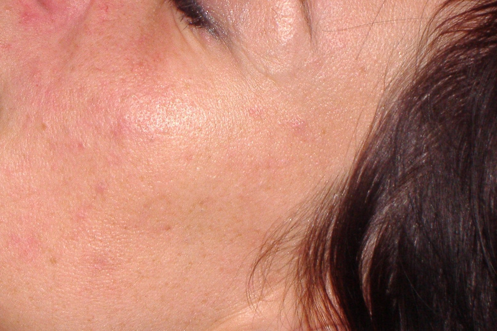 Laserové ošetření akné a jizev po akné