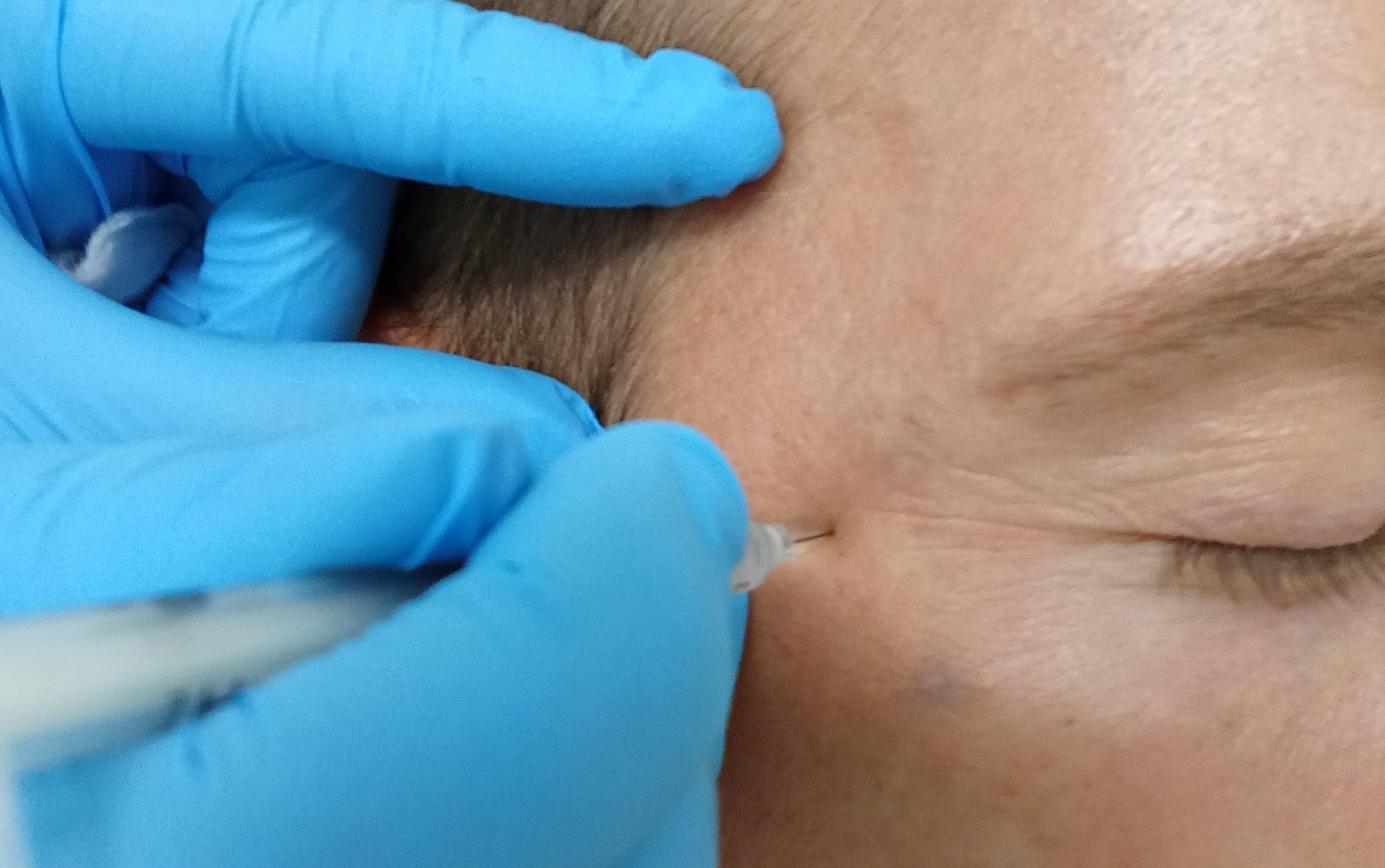 Poslední volné termíny do konce roku - korektivní dermatologie